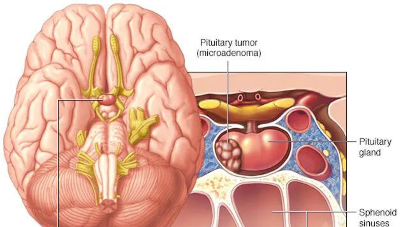 Brain Tumor Day
